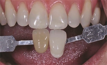 New Science in the World of Whitening   Registered dental hygienists Mary Jane Livingston and Jennifer Vasquez answer commonly asked whitening questions, such as long-term effects on enamel, techniques to reduce tooth sensitivity, and maintenance recommendations for patients.