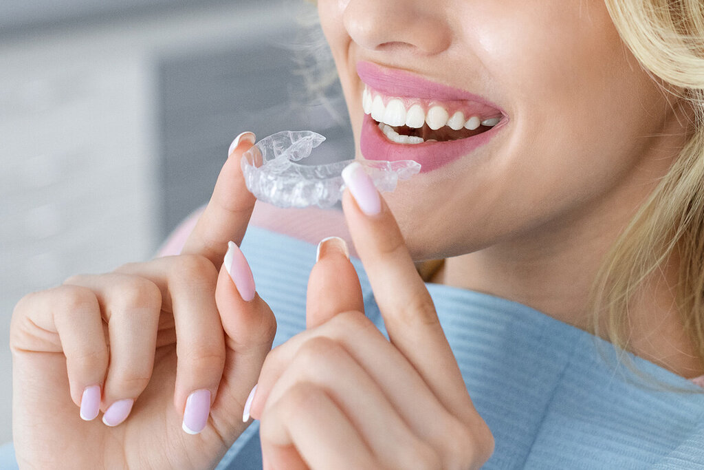 Hygiene During Clear Aligner Treatment: A Chairside Guide to Attachments, Trays, and White Spots